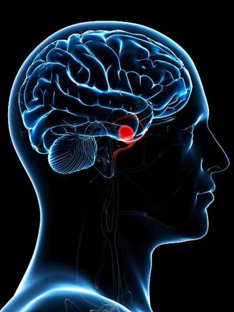 Aneurysm Information